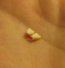My Two Front Teeth